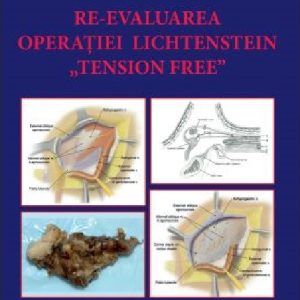 Re-evaluarea operatiei Lichtenstein „tension free” | Florin Gavrilas